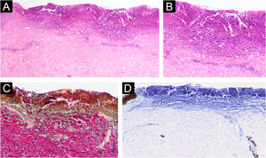 Histological and immunohistological findings. Skin biopsy pathology showed a central erosion filled with a cup-shaped keratinous plug containing numerous inflammatory cells and collagen fibers, and perivascular infiltrates consisting of lymphocytes and eosinophils in the dermis (A, Hematoxylin & eosin, x40; B, Hematoxylin & eosin, x200). Elastica van Gieson staining visualized vertically trans-eliminated collagen fibers from the underlying dermis through the plug (C, ×200). Immunostaining using anti-pankeratin AE1/AE3 antibody revealed no periappendage materials within the plug (D, ×40).