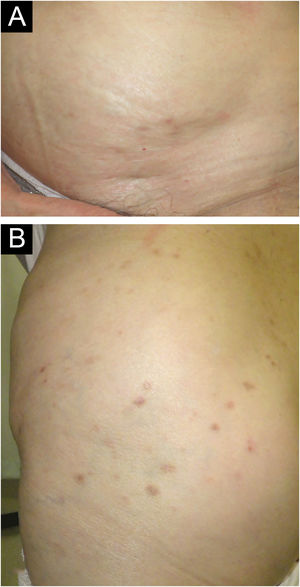 Clinical findings after treatment. After 6 months of oral dapsone treatment, all the eruptions flattened and almost disappeared with mild pigmentation (A, B).