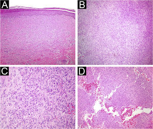 (A) Atrophic dermatofibroma. The lesion is hypocellular, and exhibits marked hyalinization. (Hematoxylin & eosin, ×200) (B) Cellular dermatofibroma with noticeable cellularity. (Hematoxylin & eosin, ×100) (C) High magnification of cellular dermatofibroma showing prominent mitotic figures. (Hematoxylin & eosin, ×400) (D) Aneurysmal fibrous histiocytoma. Cystic spaces filled with blood are observed within the lesion. (Hematoxylin & eosin, ×200).