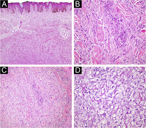 (A) Fibrous histiocytoma with atypical features. Marked nuclear pleomorphism is evident (Hematoxylin & eosin, ×200). (B) Fibrous histiocytoma with atypical features. Bizarre nucleated cells are observed (Hematoxylin & eosin, ×400). (C) Lipidized fibrous histiocytoma. At low magnification, significant hyalinization is noticeable in the lesion (Hematoxylin & eosin, ×40) (D) Foamy cytoplasmic appearance in the cytoplasm of lesional cells (Hematoxylin & eosin, ×400).