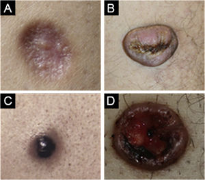 (A) Atrophic dermatofibroma. (B) Cellular dermatofibroma. (C) Aneurysmal dermatofibroma. (D) Lipidized dermatofibroma.