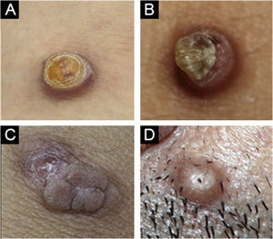 (A) Cellular dermatofibroma case with pre-diagnosis of eccrine poroma. (B) Common dermatofibroma case with a pre-diagnosis of keratoacanthoma. (C) Cellular dermatofibroma case with a pre-diagnosis of irritated skin-tag. (D) Common dermatofibroma case with a pre-diagnosis of trichofolliculoma.