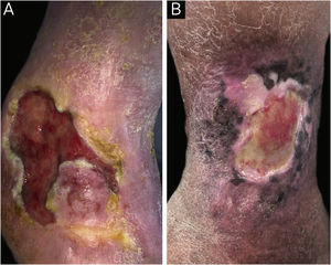 (A) Patient with venous ulcer and peri-ulcer eczema characterized by pruritus, erythema and desquamation. The patch test showed a positive reading at 72 hours, with relevance for lanolin, paraben mix, hydrogel, silver sulfadiazine, elastic bandage, Unna’s boot, collagenase with chloramphenicol and hydrofiber with silver. (B) Patient with venous ulcer and peri-ulcer eczema. The patch test did not show a positive result with the standard battery; however, the patch test with dressings showed a positive test at 72 hours for hydrogel and collagenase with chloramphenicol.