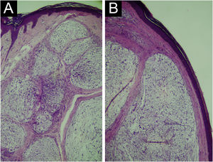 Light Microscopy (A) Rectified epidermis. Dermis with proliferation of spindle-shaped and stellate cells embedded in a myxoid matrix, forming well-circumscribed lobes, separated by fibrous septa (Hematoxylin & eosin, ×40). (B) Proliferation of spindle-shaped and stellate cells, forming well-circumscribed nodules, separated by fibrous septa (Hematoxylin & eosin, ×100).