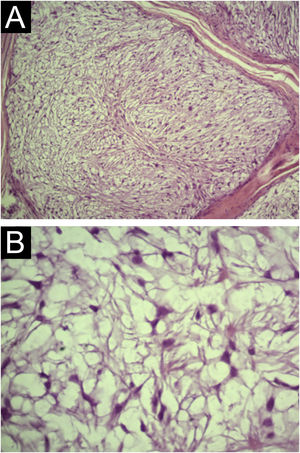 Light Microscopy (A) Cellular atypia or mitoses are not observed (Hematoxylin & eosin, ×100). (B) Detail of stellate and spindle-shaped cells without atypia (Hematoxylin & eosin, ×400).