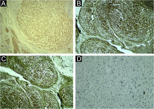 Immunohistochemistry (A) anti-S100 protein antibody positive in the neoplastic cells and in the adjacent nerve, in the left low corner (×100). (B and C) vimentin antibody showing positivity in the neoplastic cells (×100). (D) Ki67 antibody indicating a low cell proliferation index (×100).