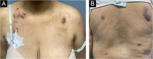 Clinical appearance of patient with cutaneous amebiasis at the first dermatological consultation: nodular lesions and tumors on the abdomen, anterior and posterior thorax covered by slightly desquamative erythematous-violaceous skin; some lesions showed spontaneous drainage of purulent secretion.