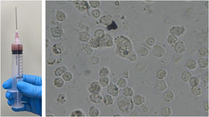 Direct examination of secretion collected by ultrasound-guided puncture (A) showing the parasite Entamoeba histolytica in the form of cysts and, in the center of the image (B), trophozoites.