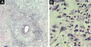 Histopathology. (A) Skin section showing an histiocytic reaction surrounding abscesses in the superficial and deep dermis (Hematoxylin & eosin, ×40). (B) Evidence of Entamoeba histolytica trophozoites with similar morphology as on direct examination (Hematoxylin & eosin, ×1000 under immersion oil).