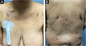 Clinical appearance of the patient with cutaneous amebiasis after treatment with metronidazole and ivermectin, showing only residual lesions.