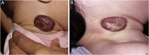 Case 12. Mixed infantile hemangioma in the right cervical region. (A) Before the treatment. (B) Partial response after the treatment.