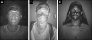 Increasing scale of area of application of the sunscreen. *Areas shaded in black on the face of the volunteer corresponding to (A) 15.53%, (B) 56.19% and (C) 100% of sunscreen surface cover.