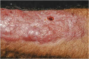 Primary cutaneous cryptococcosis (PCC): Infiltrated, erythematous plaque with raised surface, showing a tumor-like aspect. Rare ulcerated or necrotic spots. Forearm of an immunocompetent 66-year-old male patient, post-trauma.