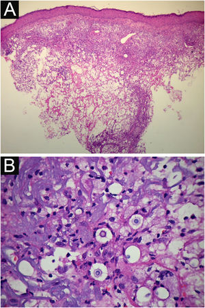 PCC: (A) Histopathology. Slightly acanthotic epidermis and dermal inflammatory infiltrate, surrounding a large clear area. (Hematoxylin & eosin ×40). (B) Detail showing histiocytic and lymphocytic infiltrate, basophilic degeneration of collagen and fungal cells with basophilic central nucleus and mucoid capsule (Hematoxylin & eosin ×200).