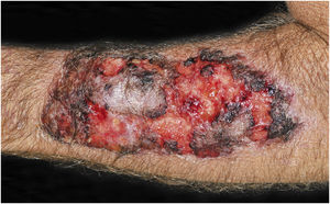 PCC: Ulceronecrotic lesion with precise limits, absence of inflammatory halo. Forearm of an immunocompetent 58-year-old male patient, post-trauma.