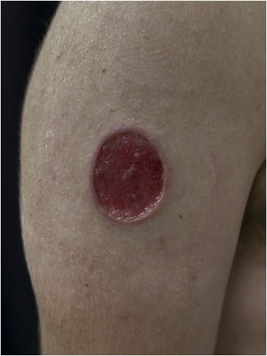 PCC: Ulcerated lesion, granular background, with borders framing the lesion in a leishmaniasis-like appearance on the deltoid region of a 31-year-old male patient, a kidney transplant recipient after seven years. The patient was receiving prednisone 5 mg and tacrolimus 0.2 mg/kg/day.