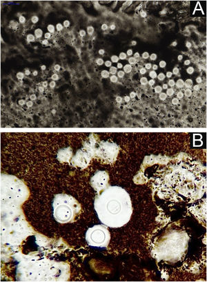 PCC: Direct mycological examination. (A) Indian ink. (B) Detail: fungal cell with mucoid capsule highlighted by contrast with the black color of Indian ink.