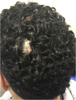 Dissecting cellulitis of the scalp: initial lesions are generally characterized by single nodules and non-scarring patches of alopecia.