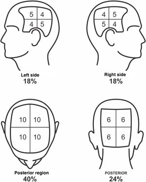 SALT score for determining the area of ​​hair loss secondary to AA. The image shows the percentage of each region and the subdivision of these into quadrants. The evaluator must estimate the area of ​​alopecia in each region and add them together. Areas of alopecia include those with no hair or thin hair, and areas that are necessarily re-grown with terminal hair. The SALT score will result from the sum of these values. For example, a patient with alopecia that affects half of the upper region and a quarter of the posterior region will have a SALT score of 20 + 6 = 26.