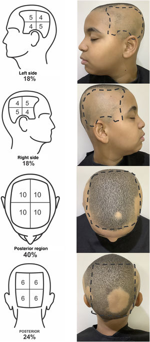 Example of the SALT Score evaluation in a patient with alopecia areata: 14 (left side) +14 (right side) +2 upper region +6 posterior region = SALT Score 36.