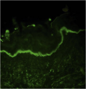 The direct immunofluorescence examination demonstrates a continous linear IgA deposition along the basement membrane zone in a patient with linear IgA bullous dermatosis.