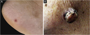 Clinical image of EP and EPC. (A) EP manifested as a well-circumscribed, small papular on the foot. (B) EPC manifested as a dark red nodule on the face with ulceration and crusting.