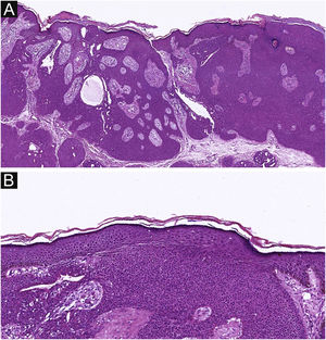 The histological appearance of EP. (A) well-defined neoplasm connected to the epidermis. (B) The oncocytes are cytologically bland without ulceration. A, 20×; B, 100×.