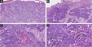 The histological appearance of EPC. (A) A neoplasm with infiltrating growth pattern. (B) The malignant cells have hyperchromatic, disorderly arrangement, and atypical nuclei with mitoses,ductal structures and ulceration. (C) Some show area of central necrosis and cytological atypia. (D) Tumor necrosis, disorderly arrangement and mitoses are present. Original magnifications: A, 20×; B, 100×; C, 200×; D, 200×.