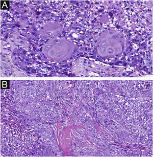 Focal squamous differentiation and spindle changes in EPC. (A) Squamous differentiation. (B) Spindle changes. Original magnifications: A, 200×; B, 100×.