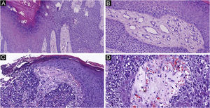 Delicate fibrovascular stroma and sharp demarcation of EP and EPC. (A) Normal keratinocytes and well-formed poroma cells are seen in this field, with a clear demarcation between them in EP. (B) A delicate fibrovascular stroma of EP. (C) This lesion shows a sharp demarcation between normal keratinocytes and poroma cells with nuclear pleomorphism and hyperchromatism in EPC. (D) A delicate fibrovascular stroma of EPC. Original magnifications: A, 100×; B, 200×; C, 100×; D, 200×.