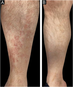 (A) Lesions on right leg in a 62-year-old man with stage IA MF. (B) Clinical complete response at week 16 of treatment with clobetasol propionate.