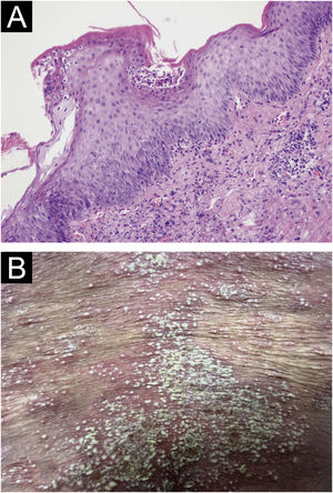 (A) Biopsy results from the skin folds under the breast: Epidermal hyperkeratosis with mild parakeratosis, focal neutrophilic aggregates forming microabscesses in the stratum corneum, thinning of the granular layer, acanthosis in the spinous layer, mild spongiosis in the spinous layer, and dermal perivascular infiltration of inflammatory cells including lymphocytes, histiocytes, and neutrophils (Hematoxylin & eosin, ×200); (B) Localized pustules at admission.