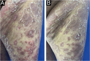 (A) Skin lesions on the left thigh 1-day before Spesolimab treatment; (B) Changes in skin lesions on the left thigh 1 day after Spesolimab treatment.