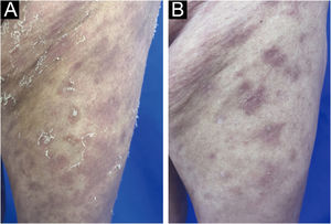 (A) Changes in skin lesions on the left thigh 5-days after Spesolimab treatment; (B) Changes in skin lesions on the left thigh 3-months after Spesolimab treatment.