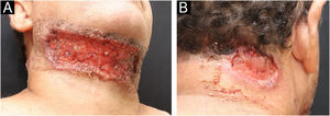 Ulcers with a granular bottom and undermined erythematous-violaceous edges in the anterior cervical region (A) and right side of the posterior cervical region (B).