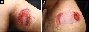 Lesions in the anterior region of the left arm (A) and left shoulder (B).