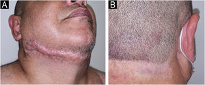 Complete healing of anterior (A) and right posterior (B) cervical lesions after treatment with infliximab.