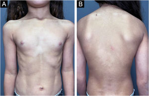 Clinical aspect of the diagnosis of leprosy, with multiple hypochromic macules distributed on the anterior and posterior trunk.