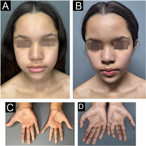 Patient before treatment (A and C) and on the day of the diagnosis of methemoglobinemia (B and D) showing central and extremity cyanosis, associated with complaints of dyspnea and fatigue.