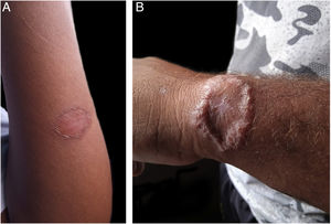 Photographs sent by patients: healed (A) and treatment failure (B).