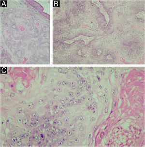 (A) Histopathology of sebaceous carcinoma in the left mandibular region (Hematoxylin & eosin, 10x). (B) Histological examination revealed the presence of disordered invasion of the dermis by ill-defined lobules of atypical sebocytes (Hematoxylin & eosin, ×100). (C) In a higher power view, atypical sebocytes can be observed in this tumor (Hematoxylin & eosin, ×400).