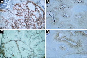 Immunohistochemical examination of a skin biopsy of sebaceous carcinoma from the left mandibular region of a patient with MTS. Immunohistochemical examination demonstrated the expression of mismatch repair genes (A) MLH-1 present (×40), (B) loss of MSH-2 (×400), (C) loss of MSH-6 (x40) and (D) loss of PMS-2 (x400).