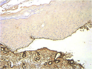 Collagen IV immunohistochemistry performed in an EBA patient (×10). Positivity is observed in the roof of the blister and in dermal structures that contain collagen IV, such as vessel walls.