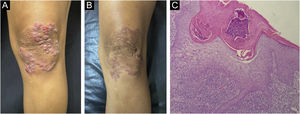 (A) Lupus vulgaris – erythematous-violaceous, infiltrated plaque with keloid-like surface on the left knee. (B) Lupus vulgaris – post-treatment lesion. (C) Lupus vulgaris – epidermis hyperplasia, crust on the surface, abundant subepidermal inflammatory infiltrate, with epithelioid granuloma, without necrosis (Hematoxylin & eosin, ×100).