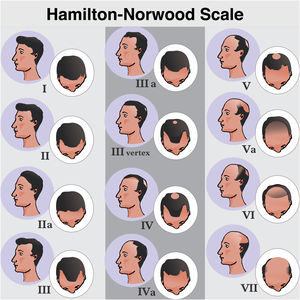 Hamilton-Norwood classification. Stage I, No apparent hair loss or minimal loss in the temporal regions; Stage II, Slight bitemporal recession, showing a symmetrical triangular shape; Stage III, Significant loss with little or no hair coverage in the temporal regions; Stage III Vertex, Hair loss is more pronounced in the vertex and the recession in the temporal region does not exceed that described in stage III; Stage IV, Significant thinning in the temporal regions and in the vertex, leaving a dense band of hair separating the two areas; Stage V, Recession of the implantation line and more evident thinning at the vertex. The band of hair separating the two regions shows even more reduced density, making the transition area less evident; Stage VI, The frontotemporal and vertex regions unite through the complete loss of the band of hair that separated them; Stage VII: More extensive form of involvement, leaving only a narrow band of hair in the lateral and occipital regions.