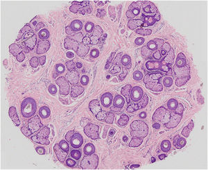 Horizontal section of a fragment of scalp skin in MAA (Hematoxylin & eosin, ×20) – 39 hair follicles at the level of the isthmus, 9 of which are vellus, and the others terminal and intermediate. Preserved follicular epithelium and sebaceous glands with enlarged lobules. All follicles are in the anagen phase, except one telogen germinal unit.