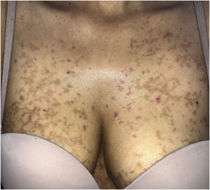 Prurigo pigmentosa: Erythematous, crusty and hyperpigmented papules in thorax.