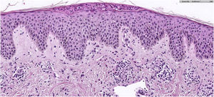 Hystopatology: Lymphocytic dermatitis with eosinophils, spongiosis, acanthosis, and a neutrophilic subcorneal pustule, findings consistent with a fully developed stage lesion of prurigo pigmentosa (Hematoxylin & eosin, ×20).