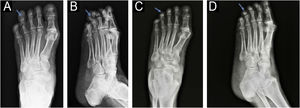 Anteroposterior (A) and lateral (B) radiographs of the left foot before the surgery: increased soft tissue density and bone erosion of the distal phalanx (blue arrow), resembling a “cup” appearance (B). Anteroposterior (C) and lateral (D) radiographs of the left foot two months after the surgery: partial recovery of bone structure.