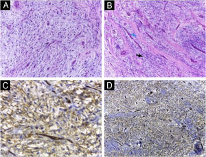 (A and B) Homogeneous spindle cell proliferation amidst myxoid stroma (A); fibrosis areas (blue arrow) alternating with myxoid stroma (black arrow) (B) (Hematoxylin & eosin; 100×). Immunohistochemical study showing neoplastic cells with diffuse expression of CD34 (C) and CD99 (D) (400× and 100×, respectively).